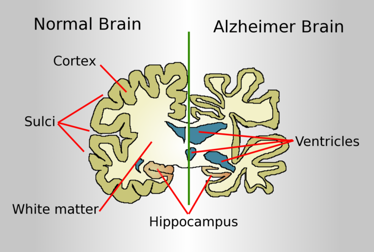 Beyond Amyloid — New Mechanisms in Alzheimer’s Disease Research